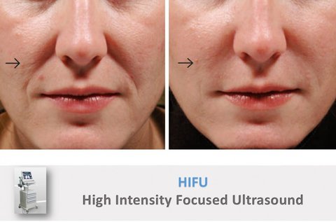 HIFU mosolyránc feltöltés fókuszált ultrahanggal