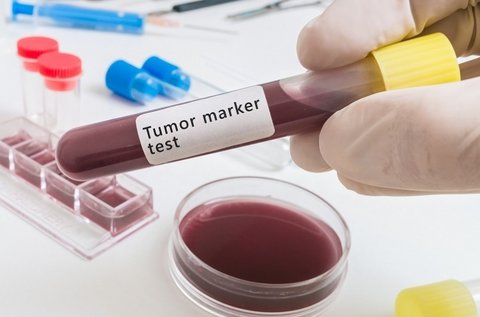 Laboratóriumi vizsgálat tumormarker szűréssel