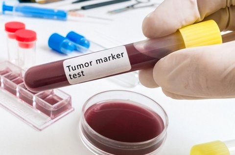 Profi rákmegelőző vizsgálat tumormarker szűréssel