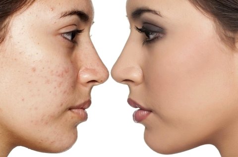 Aknés és problémás arcbőr kezelése Dermarollerrel