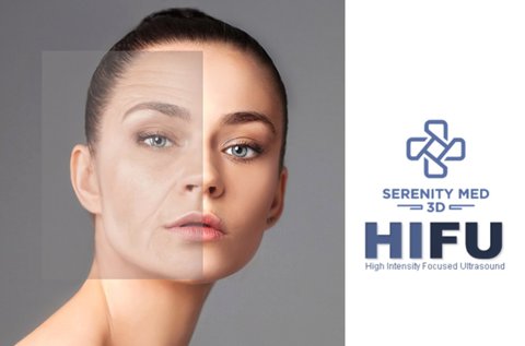 Serenity Med 3D HIFU ráncfeltöltés teljes arcon