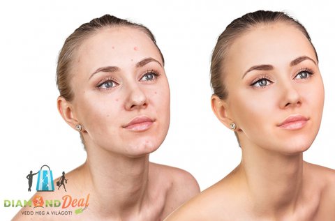 Fájdalommentes fibróma eltávolítás Plasma Pennel