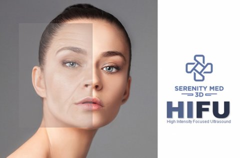 Serenity MED 3D HIFU ráncfeltöltés teljes arcon
