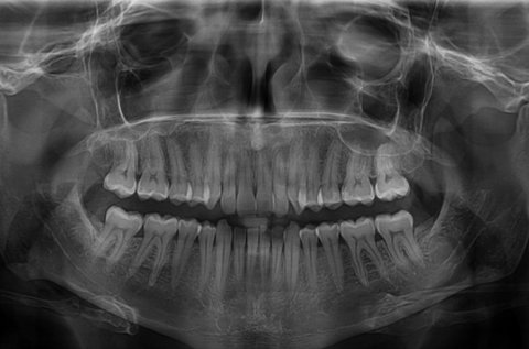 Digitális fogászati panorámaröntgen 
