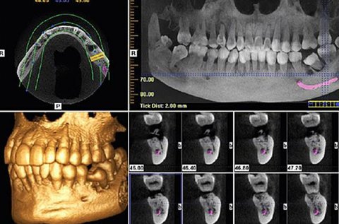 3D Cone Beam fogászati CT vizsgálat