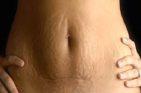 Striák, terhességi csíkok  eltüntetése mezoterápiával