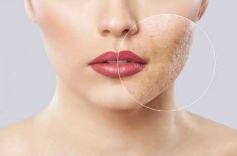 Aknés és pattanásos arcbőr kezelése Dermarollerrel