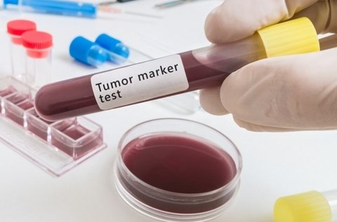 Rákmegelőző vizsgálat tumormarker szűréssel