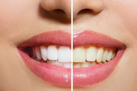 LED lámpás fogfehérítés mindkét fogíven