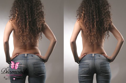 Cellulit elleni Velashape kezelés + köpölyözés