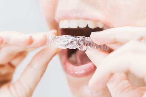 Láthatatlan fogszabályozás kivehető műanyag sínnel