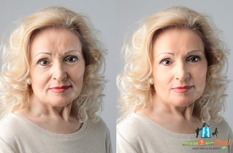 Mezopeptid kezelés a mimikai ráncok ellen