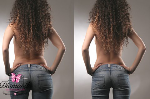 VelaShape fogyasztó kezelés köpölyözéssel