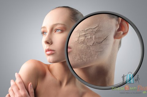 Carbon Peeling lézeres kezelés aknés bőrre
