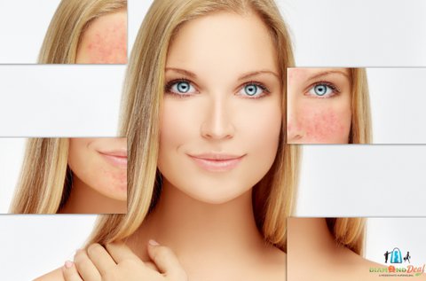 Rosacea kezelés fizikoterápiás lézerrel