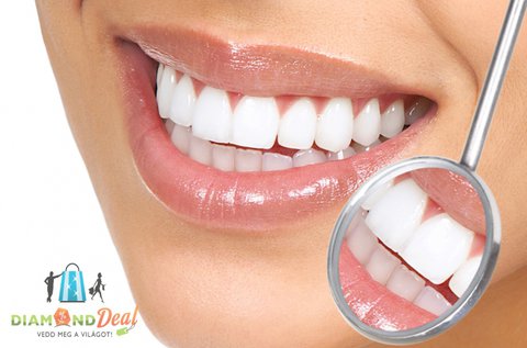 LED lámpás peroxidmentes fogfehérítés