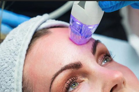 Secret RF frakcionált MicroRF arcfiatalítás