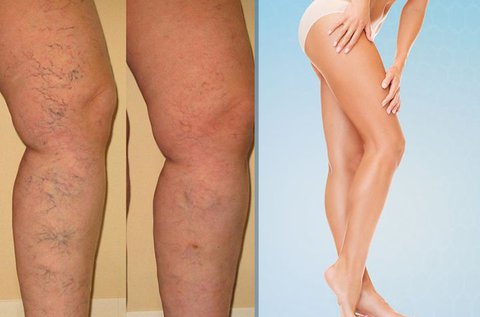 10 alkalmas visszérkezelés választható területre