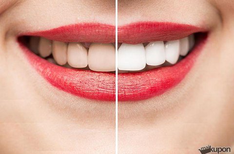 Peroxidmentes fogfehérítés polírozással