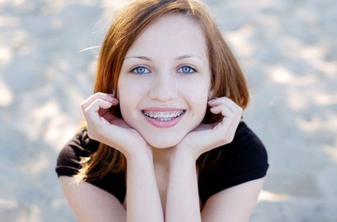 Fém fogszabályozó 1 fogívre