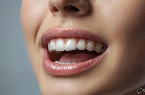 Ultrahangos fogkő-eltávolítás