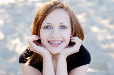 Fém fogszabályozó készülék 1 fogívre