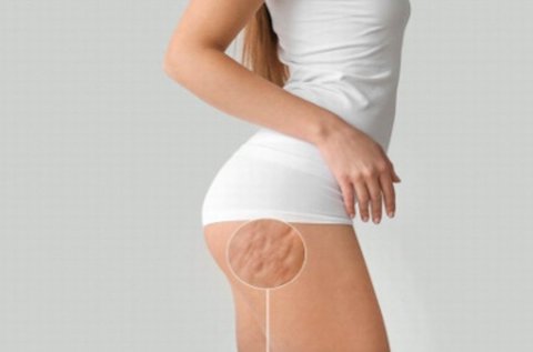 4 alkalmas bérlet a makacs zsírpárnák, cellulit ellen