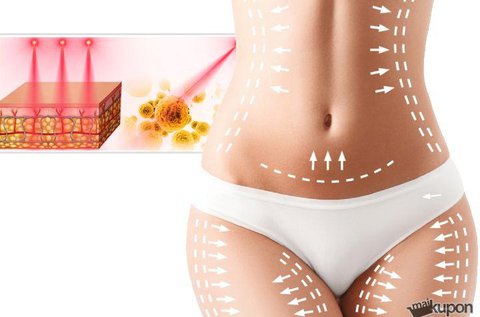 4 alkalmas lipolézeres zsírbontó kezelés