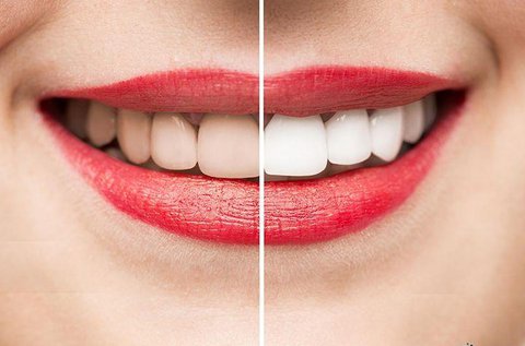 Peroxidmentes kíméletes fogfehérítés polírozással