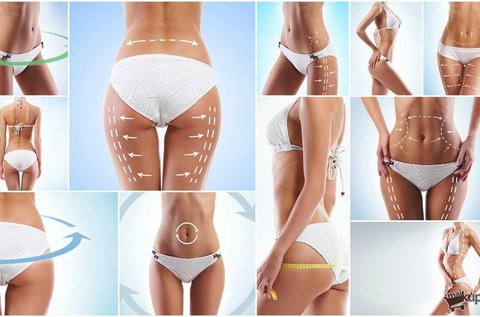 Monosculpt rádiófrekvenciás zsírbontás