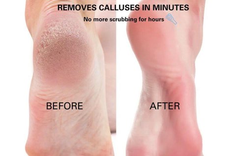 Callous Clear szett bőrkeményedések ellen