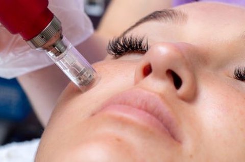 Dermapen kezelés 4D hyaluronsavakkal