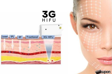 3G HIFU mikrofókuszált ultrahangos arcfiatalítás