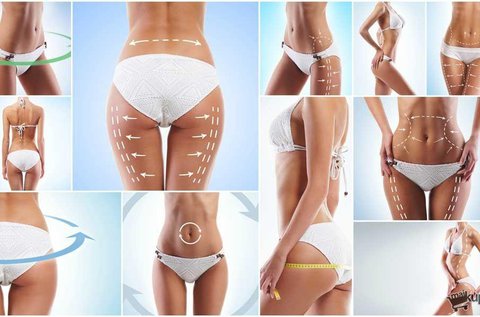 Monosculpt rádiófrekvenciás zsírbontás