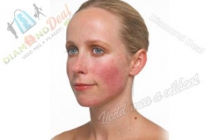 Rosacea, borvirág, seprűvénák, tűzfoltok eltüntetése RBS-C Vasculáris kezelőgéppel 2 orcára vagy bármely megegyező méretű bőrfelületre