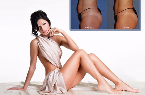 Ultrashape HIFU végleges zsírbontás
