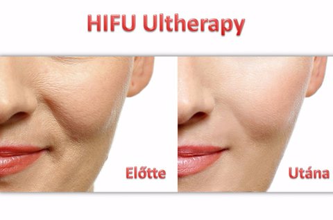 UltraLift HIFU mosolyránc feltöltés