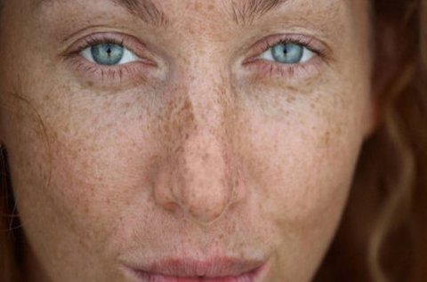 Májfolt eltávolítás teljes arcon vagy dekoltázson