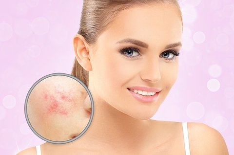RBS-C vascularis seprűvéna és rosacea kezelés