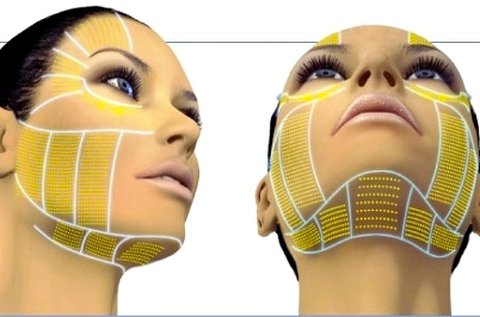 HIFU ránctalanító kezelés teljes arc és toka területen