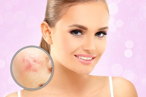 Szépséghibás bőr kezelése RBS-C vascularis géppel