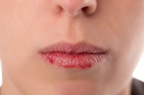 Kiszáradt cserepes ajkak feltöltése kollagénnel