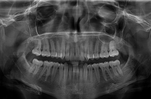 Digitális fogászati panoráma röntgen készítése