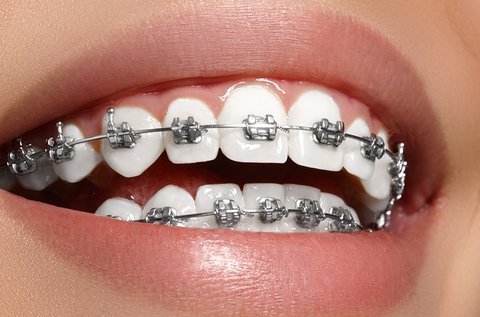 Fém rögzített fogszabályozás 1 fogívre