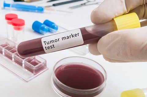 Rákmegelőző vizsgálat tumormarker szűréssel