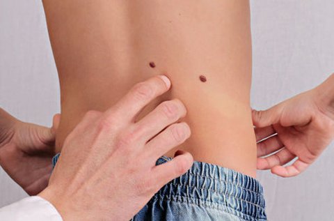 Dermatoszkópos anyajegy- és bőrbetegség szűrés