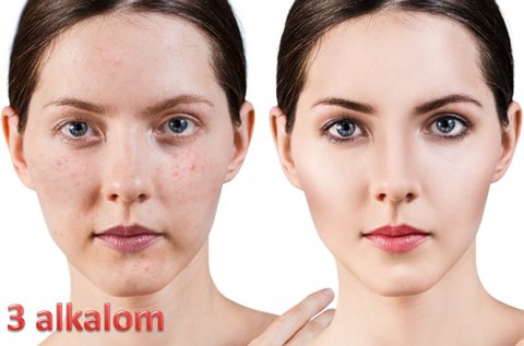 E-light fotorejuvenációs akne kezelés 3 alkalommal