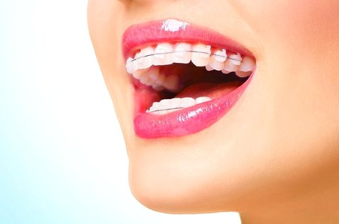 Rögzített fogszabályozó készülék 1 fogívre