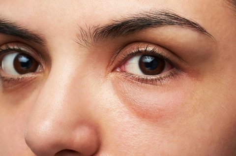 Táskás, dagadt szemek kezelése rádiófrekvenciával