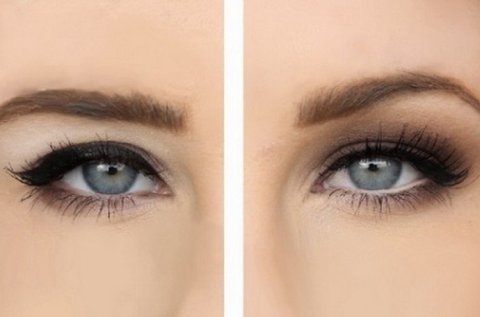 HIFU szemhéj emelés